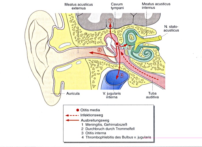 Otitis media