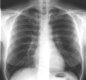 Semesterkurs Chest-X-Ray